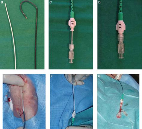 4) may be inserted at the bedside, in a home, or in the radiology setting. . Sheath vs catheter
